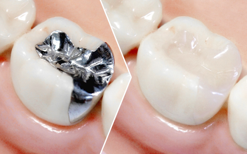 セラミック治療