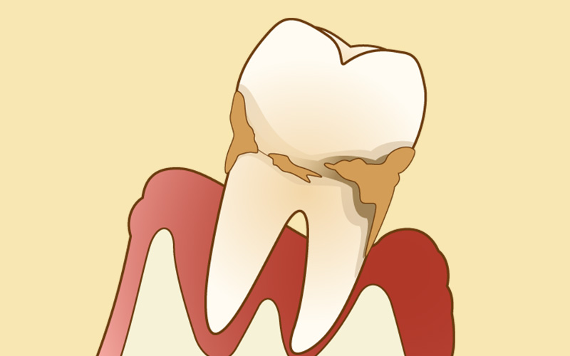 歯周病治療
