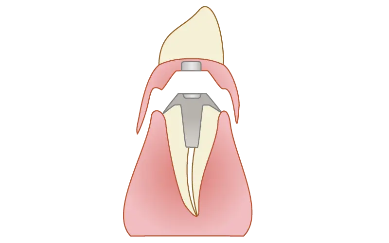 マグネットデンチャー